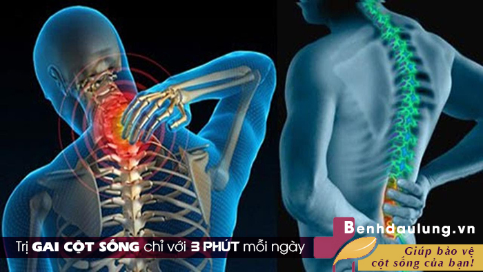 Trị gai cột sống chưa bao giờ dễ dàng hơn chỉ với 3 phút mỗi ngày! 