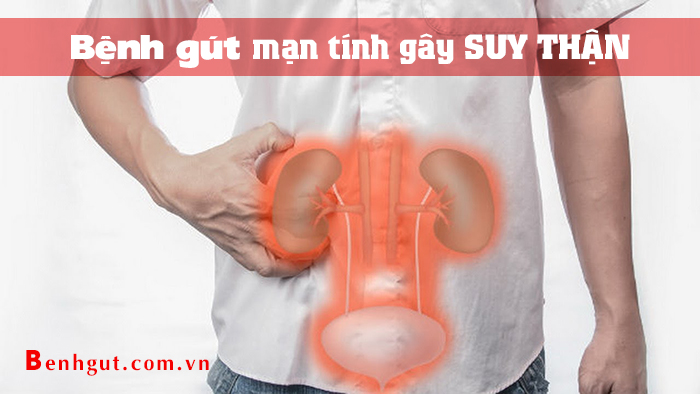 “Lạnh gáy” vì biến chứng SUY THẬN của bệnh GÚT