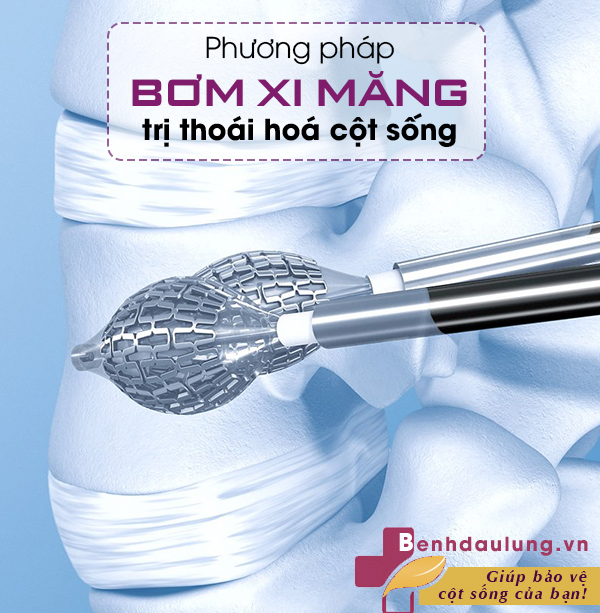 ĐỘC LẠ phương pháp bơm xi-măng: Hi vọng cho bệnh thoái hóa cột sống 