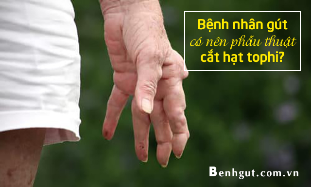 Bệnh nhân gút có nên phẫu thuật cắt hạt tophi không?