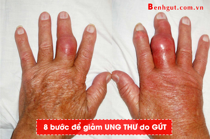 8 bước bạn có thể làm để giảm UNG THƯ do bệnh GÚT