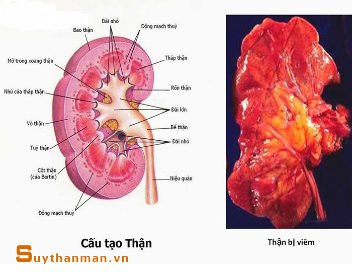 Viêm cầu thận - Nguyên nhân gây ra suy thận mạn không phải ai cũng biết