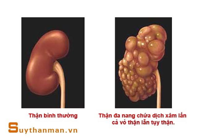 Vì sao cần phải đề phòng suy thận do bệnh thận đa nang?