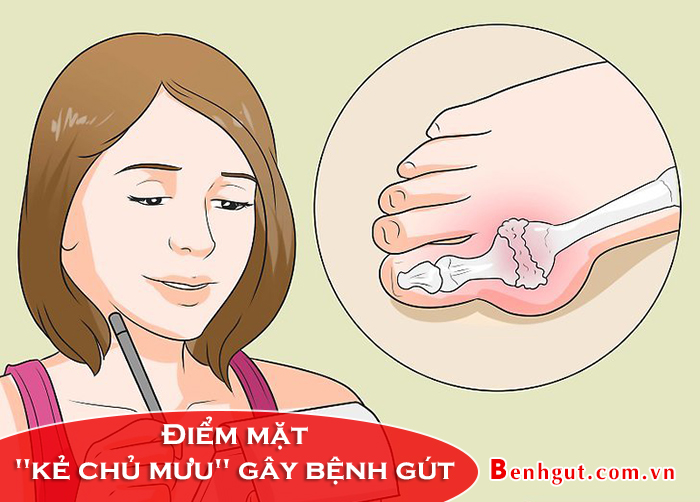  Điểm mặt gọi tên "kẻ chủ mưu" gây bệnh gút