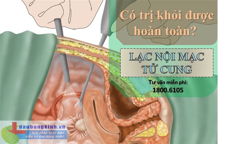 Lạc nội mạc tử cung có chữa khỏi hoàn toàn được không? 