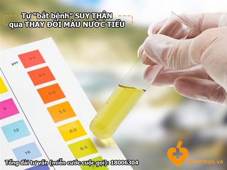 Thay đổi của nước tiểu cho thấy bạn đã bị SUY THẬN