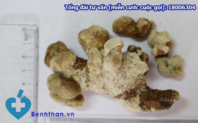 Mắc viên SỎI THẬN san hô kích thước KHỦNG 9cm! Điều trị ra sao?