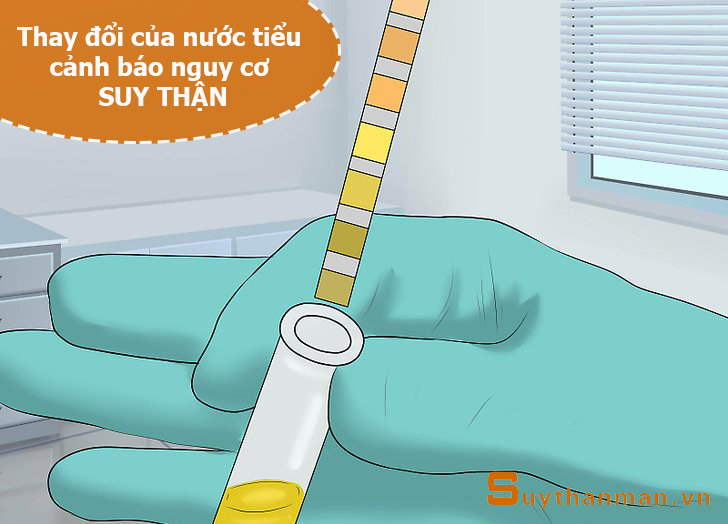 Tự chẩn đoán SUY THẬN qua 5 biểu hiện của nước tiểu