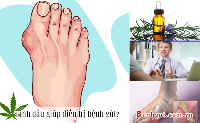 Tinh dầu giúp điều trị BỆNH GÚT, bạn đã biết chưa?