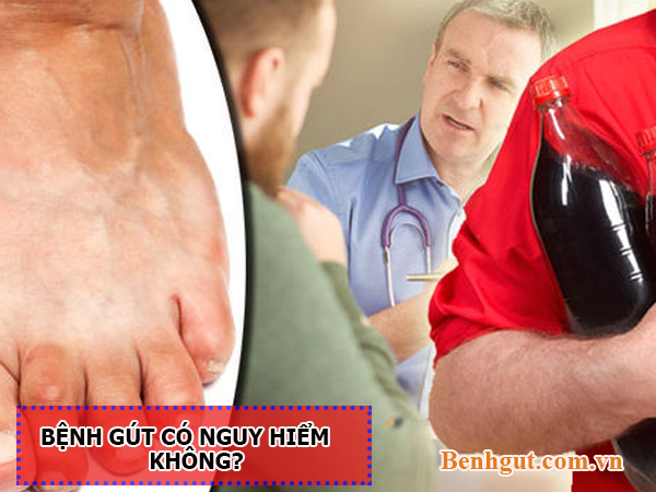 Bệnh gút có nguy hiểm không – Đọc ngay để biết câu trả lời