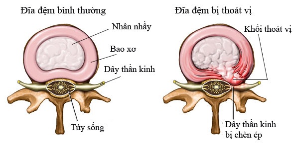 Bệnh thoát vị đĩa đệm là gì? Hãy CLICK NGAY