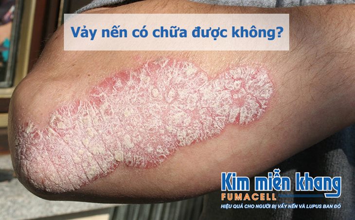 Vảy nến có chữa được không? Đây là lời giải đáp từ chuyên gia!