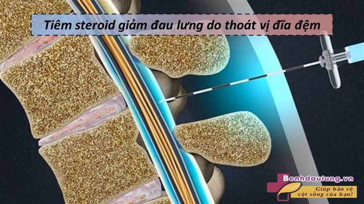 5 giải pháp chữa thoát vị đĩa đệm an toàn trả lại cuộc sống cho bạn!