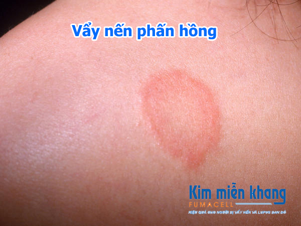 Vẩy nến phấn hồng có chữa khỏi được không?