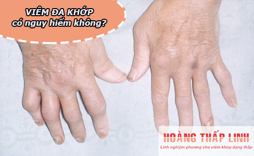 Bệnh viêm đa khớp có nguy hiểm không? - Cùng nghe chuyên gia giải đáp thắc mắc