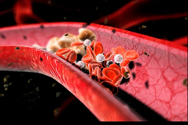 Những điều cần biết về cục máu đông: Nguyên nhân gây tai biến