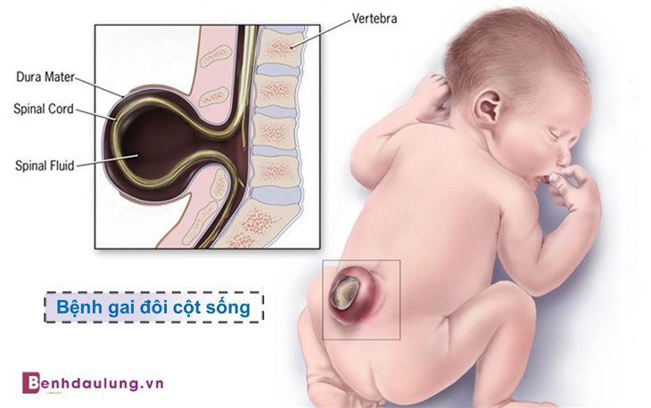 Gai đôi cột sống và bí quyết giúp bạn tránh những biến chứng nguy hiểm