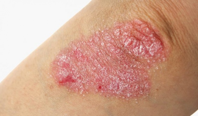 Bệnh ngoài da có vẩy là gì? Bệnh có nguy hiểm không?