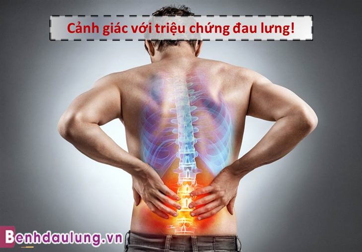 Cảnh giác tuyệt đối với triệu chứng đau lưng không rõ nguyên nhân