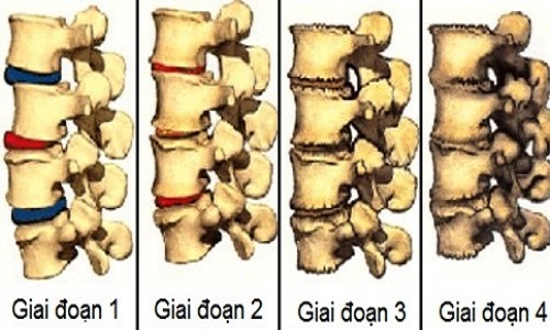 Thoát vị đĩa đệm là gì và tại sao thoát vị đĩa đệm lại gây đau lưng?