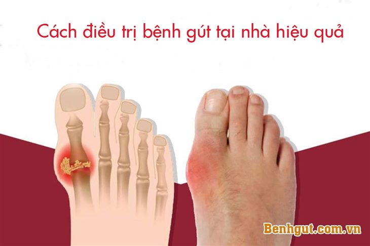 Cách điều trị bệnh gút (gout) hiệu quả hiện nay