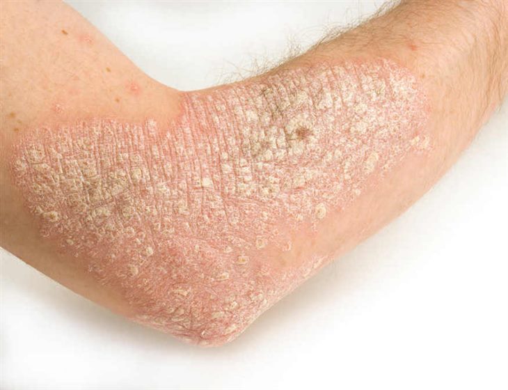 Người bị bệnh vẩy da có nên tắm nước nóng hay không? Chuyên gia Lê Văn Nhân tư vấn
