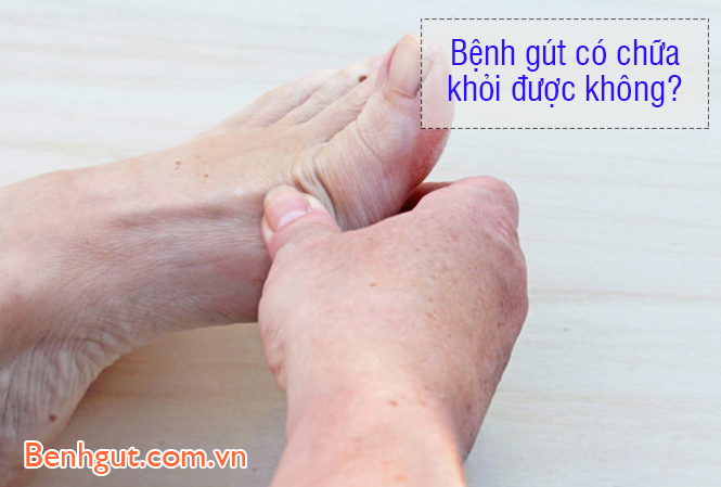 Bệnh gút có chữa khỏi được không? Lời khuyên của chuyên gia