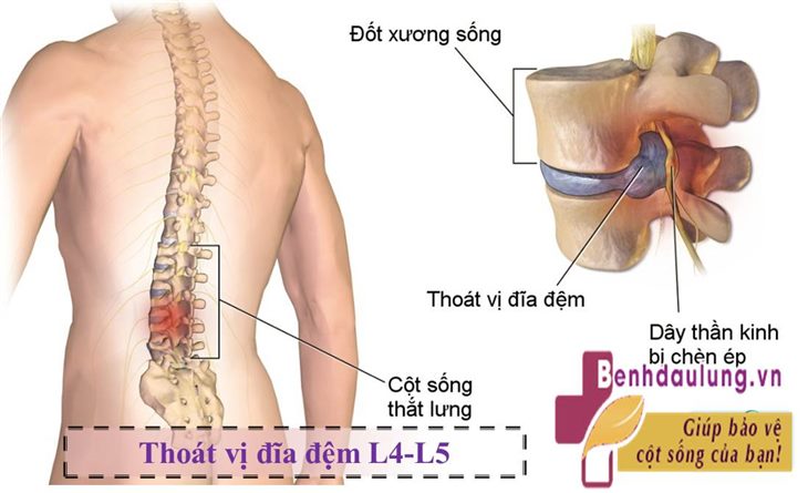 Thoát vị đĩa đệm L4-L5 không thể làm khó bạn nếu biết tới Cốt Thoái Vương