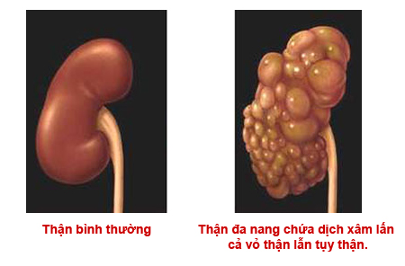 NANG THẬN là gì có nguy hiểm không? Người bị nang thận nên ăn gì thì tốt?