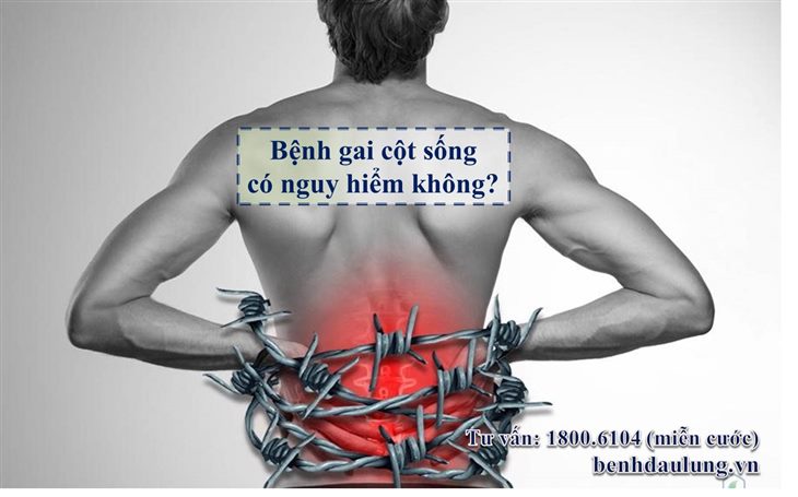 Gai cột sống lưng có nguy hiểm không? Câu trả lời ngay tại đây!