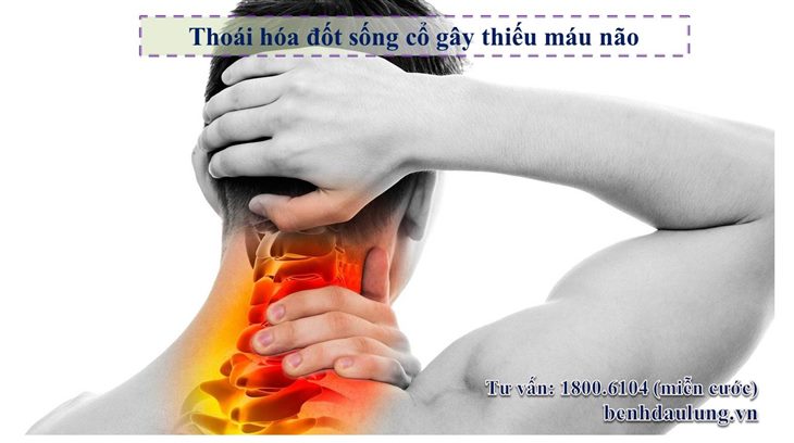 Thoái hóa đốt sống cổ gây thiếu máu não, cẩn thận hậu quả khó lường!