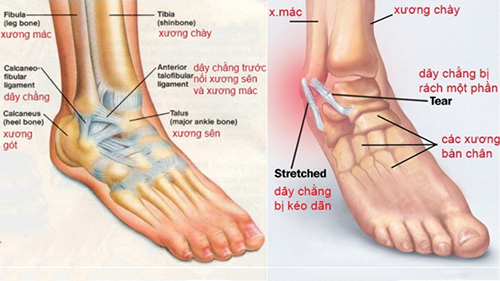 Bệnh VIÊM KHỚP MẮT CÁ CHÂN và những thói quen cần tránh