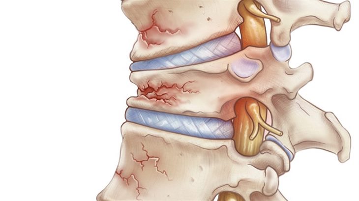 Biến chứng của thoái hóa cột sống là gì?