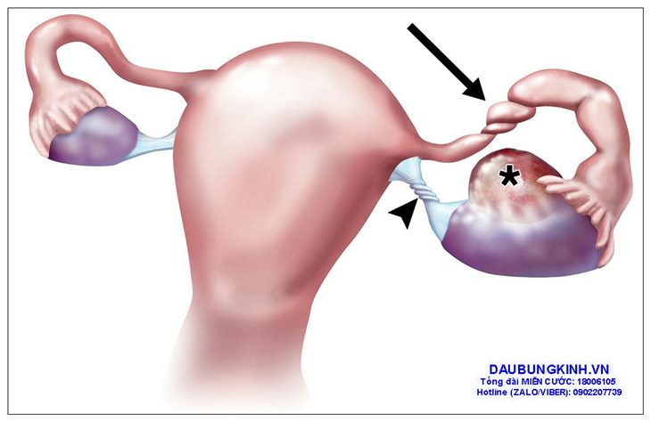 Từ triệu chứng đau bụng kinh chẩn đoán bệnh phụ khoa nguy hiểm