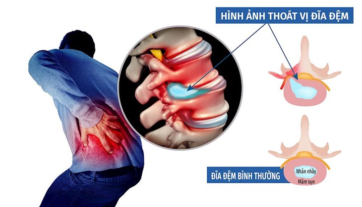 Đau thắt lưng hông là biểu hiện của bệnh gì? Chuyên gia Mai Thị Minh Tâm tư vấn