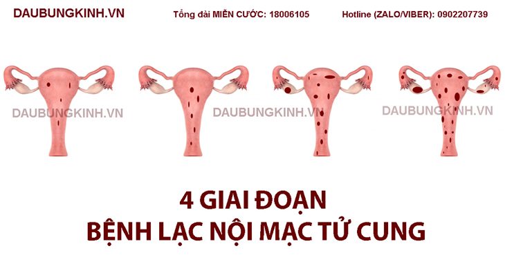 4 giai đoạn bệnh lạc nội mạc tử cung chị em nên biết