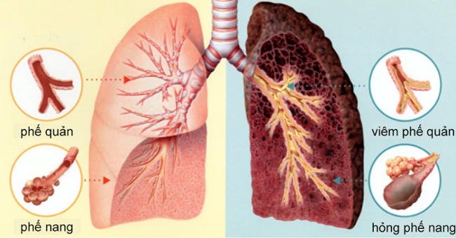 Nếu phát hiện sớm, bệnh ung thư phổi có chữa được không? Chuyên gia Phan Văn Dân tư vấn