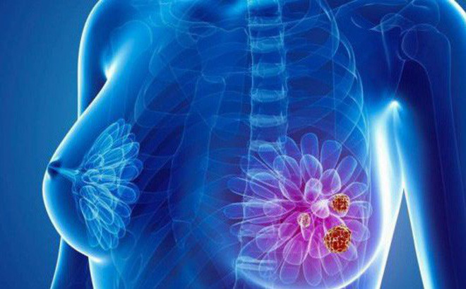 Dùng Oncolysin phòng ngừa ung thư vú tái phát có hiệu quả không? Chuyên gia Phan Văn Dân tư vấn