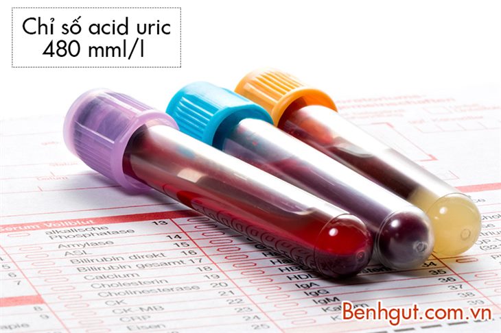 Chỉ số acid uric 480 micromol/l có phải bị bệnh gout không?