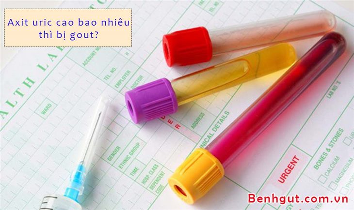 Chỉ số axit uric cao bao nhiêu thì bị gout?