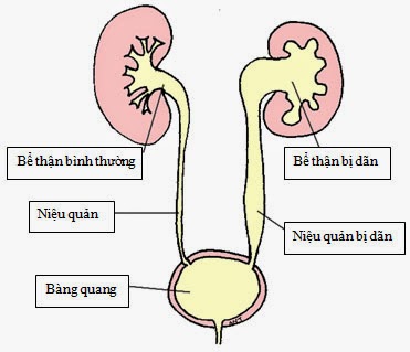 Giãn ĐÀI BỂ THẬN TRÁI 13mm có phải phẫu thuật không? – Nguyên nhân và biện pháp khắc phục