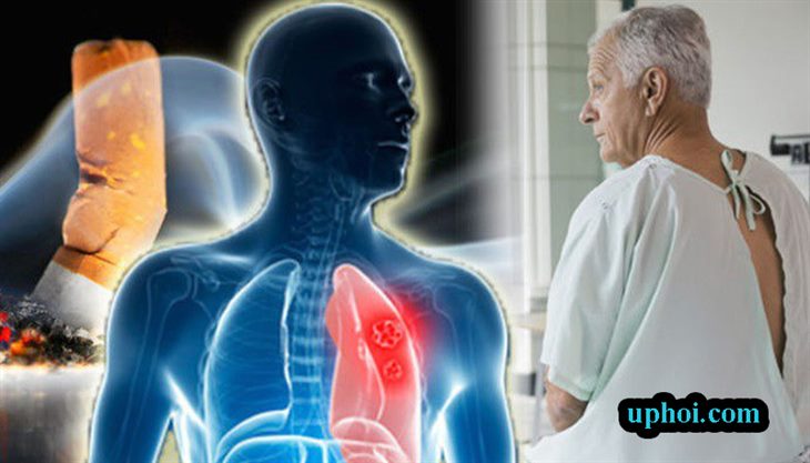 5 cách giúp bạn phòng ngừa u phổi hiệu quả. Tìm hiểu ngay!