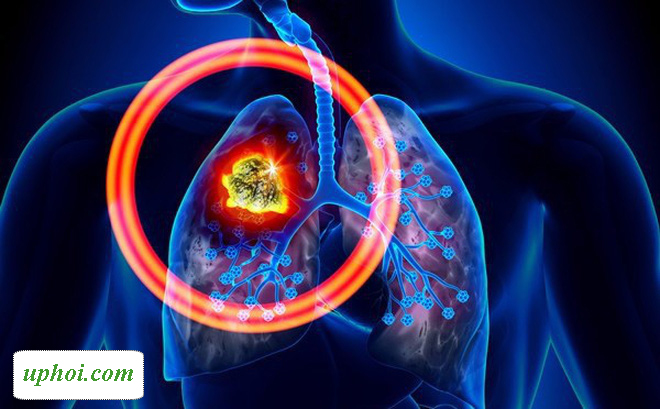U phổi là gì và những dấu hiệu nhận biết bệnh?