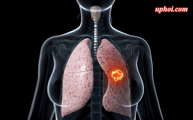 Những yếu tố nào làm tăng nguy cơ mắc u phổi? 