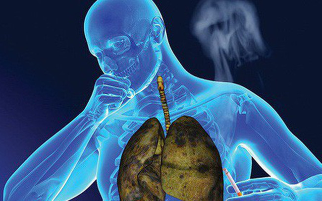 Học ngay cách nhận biết 6 dấu hiệu u phổi dễ dàng - Bạn chớ nên bỏ qua!