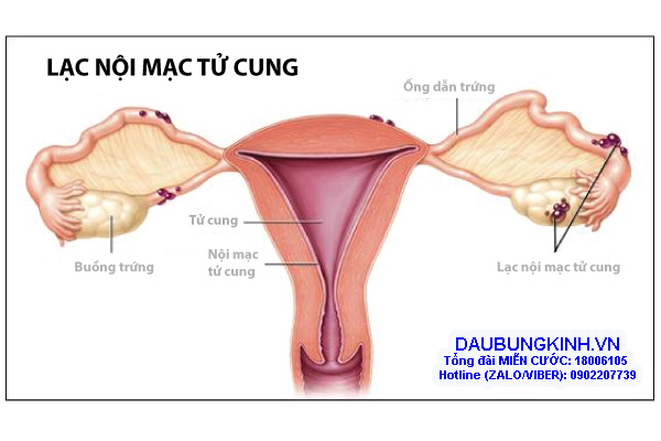 Nguyên nhân LẠC NỘI MẠC TỬ CUNG là gì? Tìm hiểu ngay trong bài viết này!