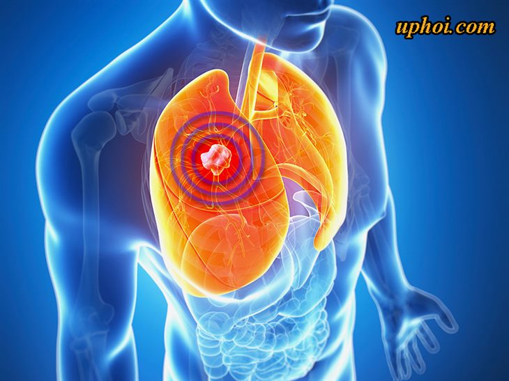 U phổi là bệnh gì? Triệu chứng và cách điều trị u phổi hiệu quả 