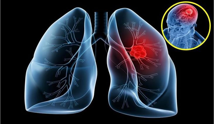 Người cao tuổi bị u phổi nên có chế độ chăm sóc và điều trị như thế nào?
