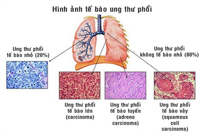 Các loại ung thư phổi thường gặp và những biến chứng nguy hiểm