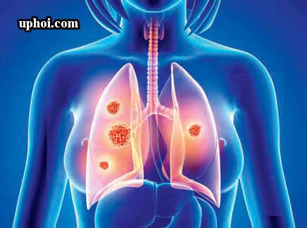 K phổi là gì? Triệu chứng và cách điều trị K phổi hiệu quả                     